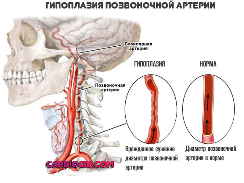 Гипоплазия-позвоночной-артерии