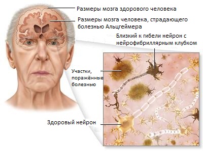 мозг больного болезнью альцгеймера